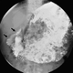 The distended stomach of a 35-year-old male competitive eater after consuming 36 hot dogs in 10 minutes. (Image: Levine et al.)